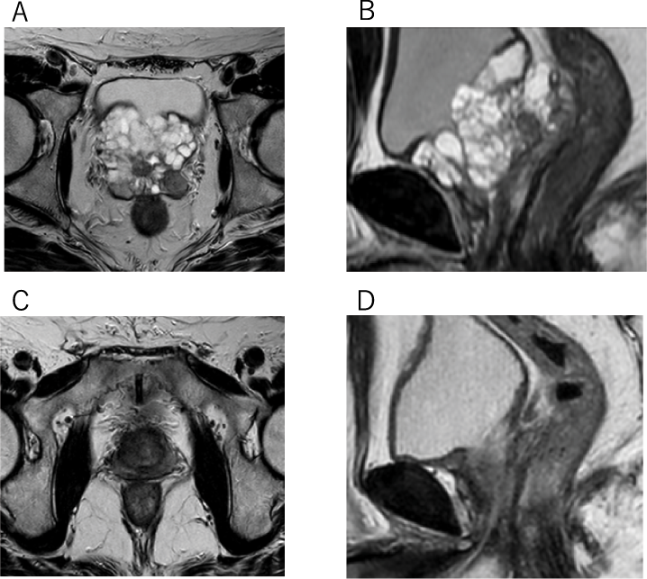 CASE REPORT: A Case Of Macrocystic Ductal Adenocarcinoma Of The ...